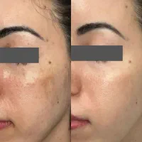 صابون روشن کننده و لایه بردار اکسونیک