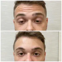 بوتاکس تخصصی زیبایی طبیعی و بدون درد