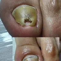 اصلاح فرم ناخن بدون روش تهاجمی
