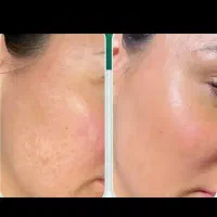 مزونیدلینگ پوست( کلاژن سازی قوی)