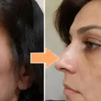 رفع لک پوست با کرم بیوممتیک تحویل ۱ روزه