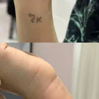 لیزر زگیل و  خالبرداری و تتو بدون برگشتن