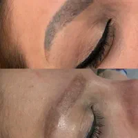 حذف تخصصی انواع تتوها مناسب برای بانوان و آقایان