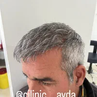 کاشت مو و ابرو برای اولین با در شهرستان مراغه