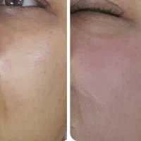 پاکسازی تخصصی مزونیدلینگ مزوایت با بهترین مواد