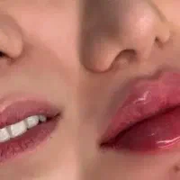 تزریق فیلر و بوتاکس توسط متخصص تخفیف ۵۰ درصدی