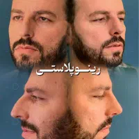 جشنواره جراحی بینی اقساط