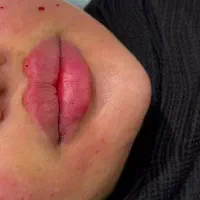 آف فوق ویژه آموزش ژل و بوتاکس