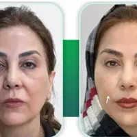 لیفت فوری بدون جراحی و ژل و بوتاکس