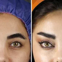 آف۲۰روز/۴۰٪لیفت شقیقه وجراح پلاستیک بدن/دستگاه پال