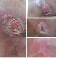 درمان اصولی و ترمیم انواع زخم ها توسط پزشک