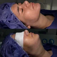 ساکشن غبغب فقط ۱۸ وی لاین مدل‌مهرزاد