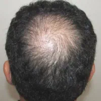 روش درمانی قطعی ریزش مو و رویش