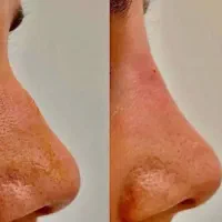 آموزش ژل،بوتاکس،لیفت،فیلربادی، مزو مو و پوست