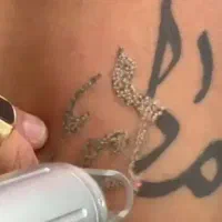لیزر مو زائد ۴۰۰ کربن تراپی صورت ۶۰۰ حذف تتو ۴۰۰