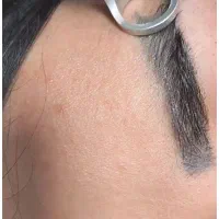 ریموو تتو ابرو و بدن با دستگاه لیزر