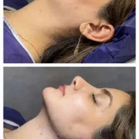 وی لاین ساکشن غبغب سوپرکانتور.تخلیه ریشه های چربی