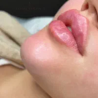 ژل لب فیلربوتاکس کلینیک زیبایی لیزر هایفو بلفارو|خدمات آرایشگری و زیبایی|مشهد, شریف|دیوار