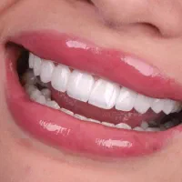 اقساط پنج ساله برای کامپوزیت، ایمپلنت، دندانپزشکی