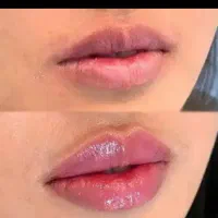 جشنواره خرداد ماه ژل و بوتاکس