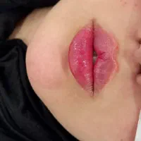 تزریق ژل و بوتاکس