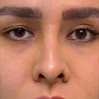 بلفاروپلاستی (جراحی زیبایی پلک)