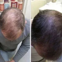 زودتر از کچلی جلوگیری کن