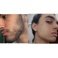 راهکار تخصصی کم پشتی ریش