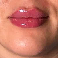 جشنواره تخفیف فیلر و‌بوتاکس و پی آرپی توسط پزشک