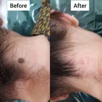 اموزش صفر تا صد پلکسر و‌کربوکسی، الگاپیل،درماپلینگ