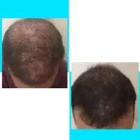 دیگه وقتشه کچل نباشی
