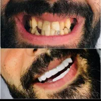 مدل کامپوزیت دندان برای تکیل البوم دوفک ۱۵