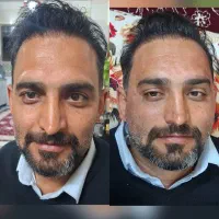 تخفیف 20 درصد ژل بوتاکس فیلر فقط دو روز
