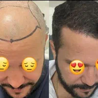 جشنوارهکاشت مو و ابرو و ریش وسبیل