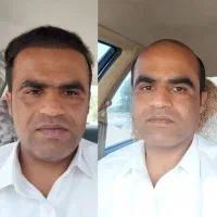 کاشت مو در چابهار