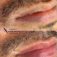 رفع کبودی لب و فرمدهی ابرو اقایان