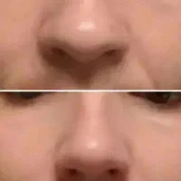 فرم دلخواه بینی۲۰روزه