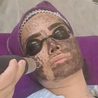 پاکسازی و فیستل تخصصی پوست افسریه