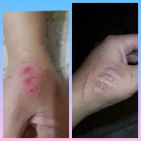 ترمیم کننده قوی زخم. جای بخیه جای جوش.