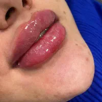 تزریق ژل.فیلرلب وچانه.فول فیس.بوتاکس.پی آرپی