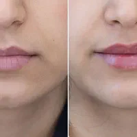 تخفیفات عیدانه ژل وبوتاکس داخل کلینیک وزیرنظرپزشک