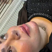 تزریق ژل وبوتاکس تزریق چربی صورت وباسن