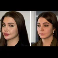بوتاکس و ژل فقط ۸۰۰تومن