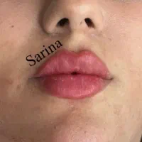 تزریق واموزش ژل و بوتاکس