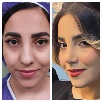جراحی زیبایی بینی با نتیجه عالی