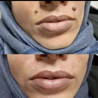 خالبرداری ،رفع کک ومک ،برداشتن میخچه توسط پزشک