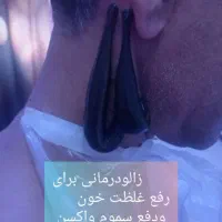 حجامت وزالو درمانی وماساژ
