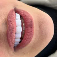 کامپوزیت دندان/ بیلیچینگ/ روکش