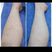 لیزر مو با دستگاه شاتی