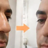 پوست شفاف و روش.ن تر با بیوممتیک